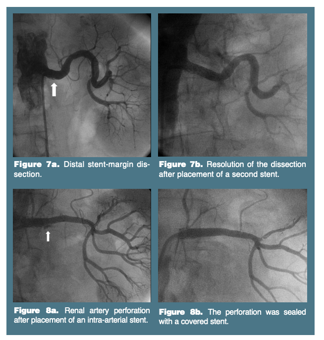 Technical Considerations for Renal Artery Stenting VDM